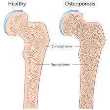 osteoporosis是什么意思
