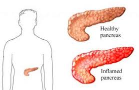 pancreatitis是什么意思