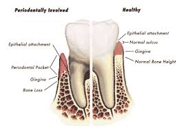periodontal是什么意思