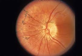 retinitis是什么意思