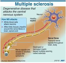 sclerosis是什么意思