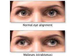 strabismus是什么意思